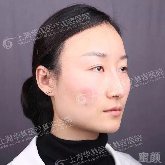 做了颌面改脸型手术后,原先的方脸变成了流畅的下颌线,整体增添了