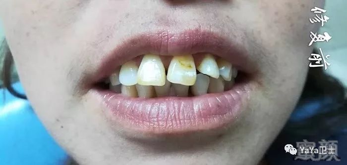 牙齿突出,牙缝宽,颜色黄,龅牙全瓷牙整形案例