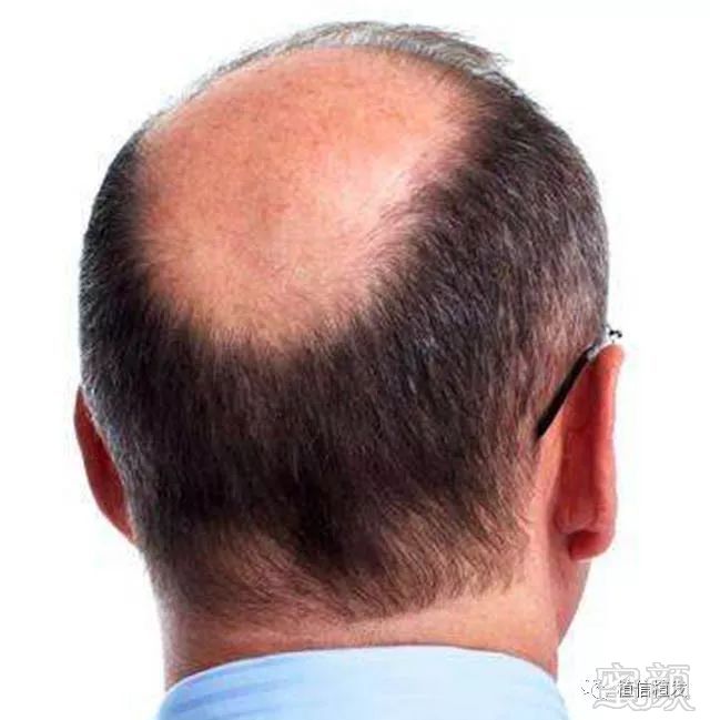 2,秃顶植发前要先确认后枕部头发情况