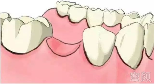 传统镶牙方式是:把缺牙两边的好牙磨小,起固位作用.