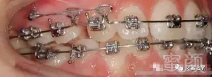 科普:牙齿矫正的利器—微种植钉(骨钉)
