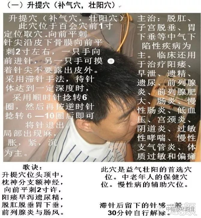针灸治百病 ,平衡针灸图解