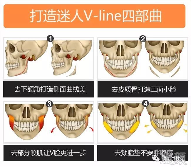 不仅是下颌角肥大,下颌缘更显得"宽厚"怎么办?