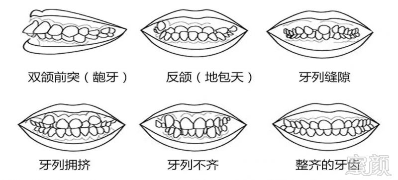 以下几种牙齿类型要及时矫正