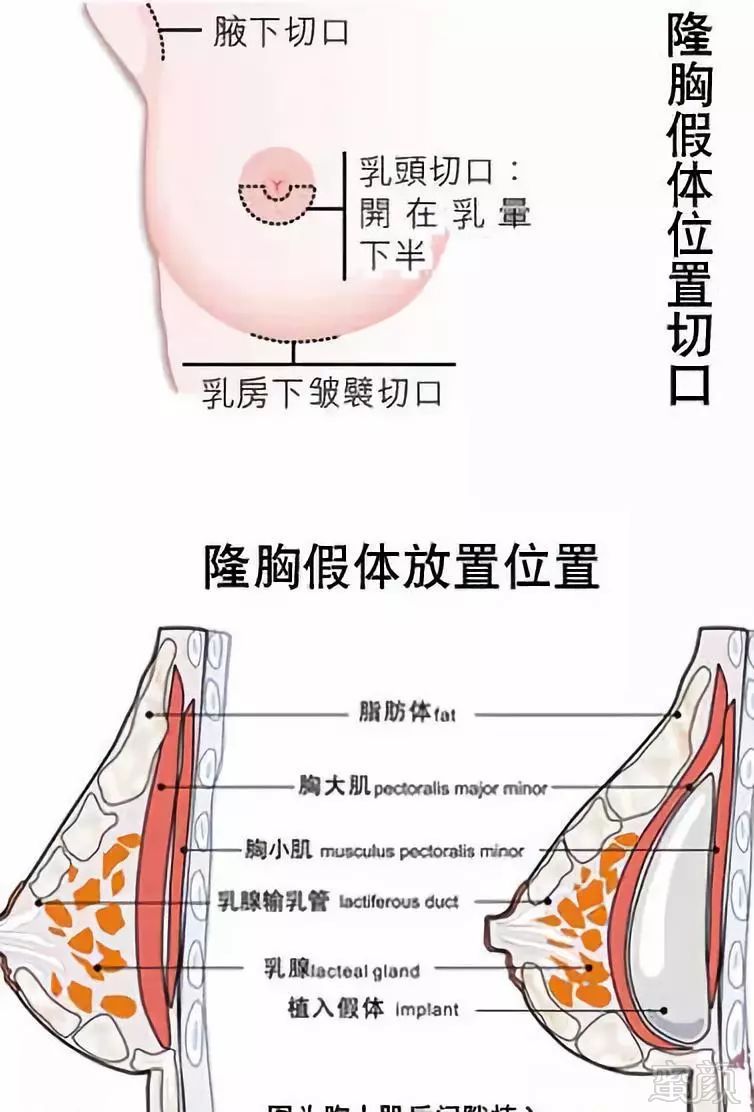假体隆胸后,手感自然的秘密,原来在这里