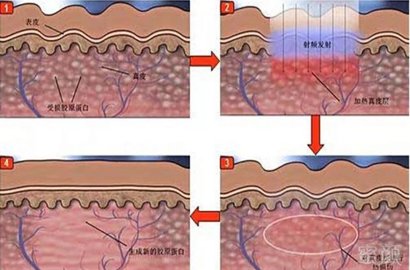 其实不容易:     要想达到促进胶原蛋白再生的效果,须让 真皮层达到