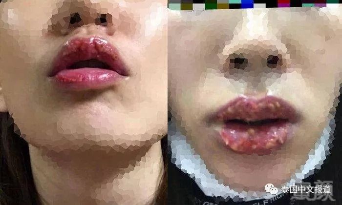 一名女子做纹唇手术,不料原本想要的粉红唇竟发生感染变成了"化脓嘟嘟