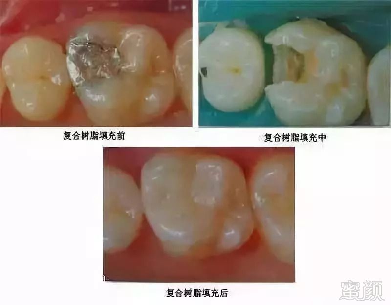 银汞合金——口腔界的"诺基亚"