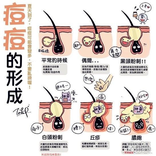 痘痘形成的不同阶段