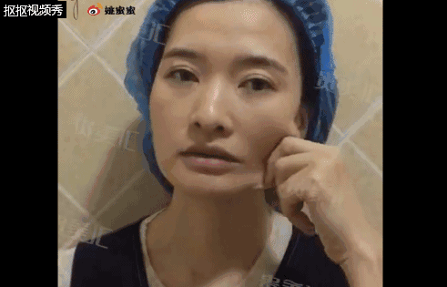 针对这种类型的脸大只需要做 日式面部提升术把松弛下垂的皮肤提