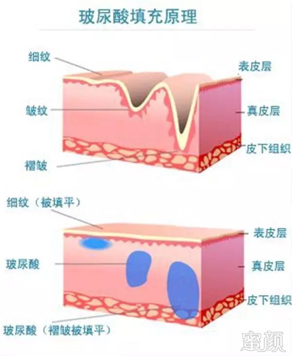 玻尿酸打多了,表情僵硬,怎么回事?