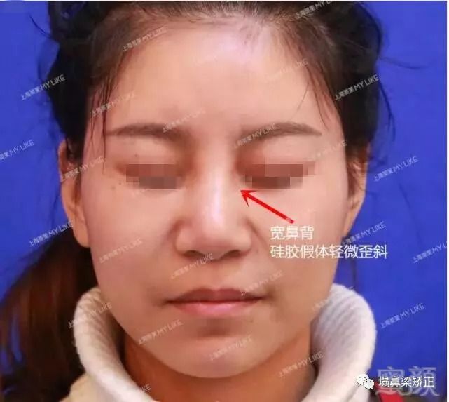 经历了注射及假体隆鼻2次失败后到上海美莱找欧阳春做