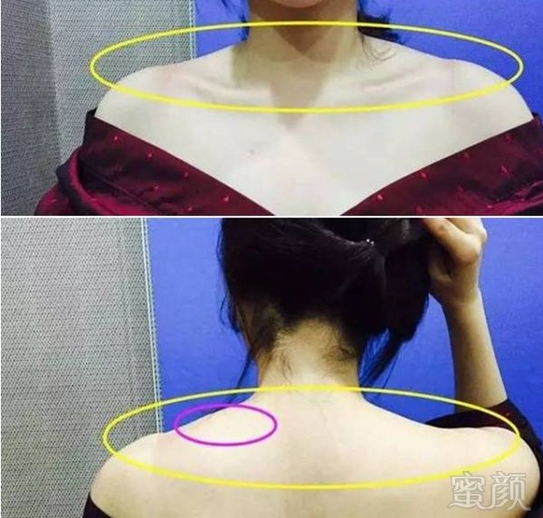 斜方肌正常的例子,就是女神刘诗诗啦,颈肩精致,连锁骨都可以放鸡蛋