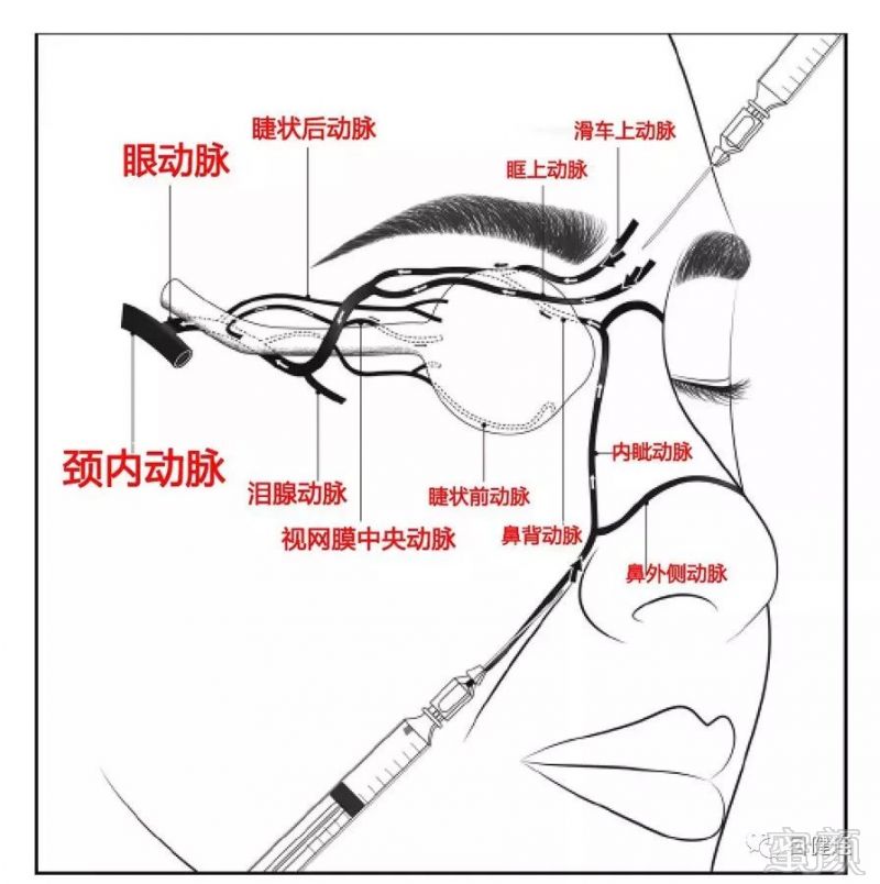 "(鼻子和嘴角组成的三角形区域),如果扎针扎得太深,针头直接扎进动脉