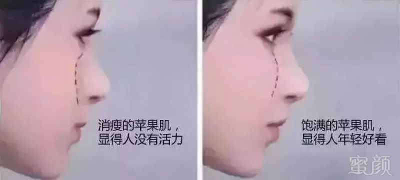 苹果肌塌了,法令纹深了,你的少女感多半是"毁"在这了