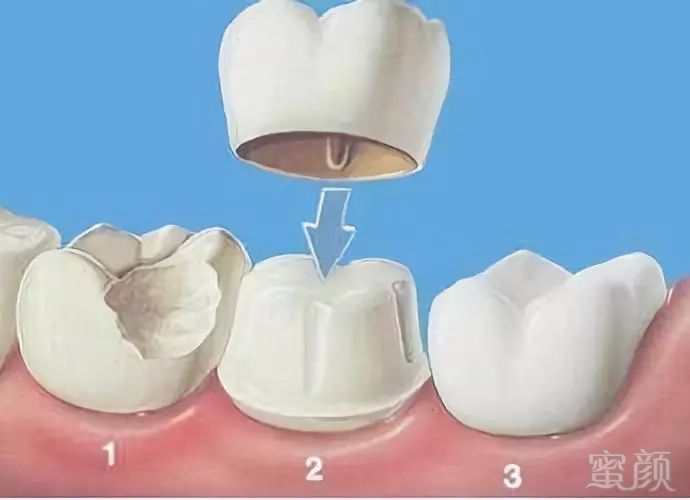 牙齿美容 | 选美容冠还是瓷贴面?