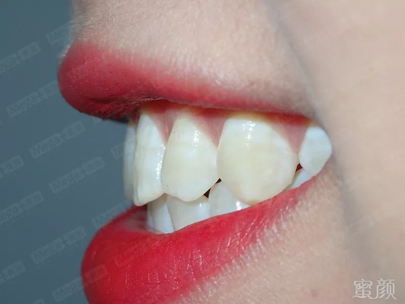 美加贴面案例 牙齿发黄需要贴面修复吗?
