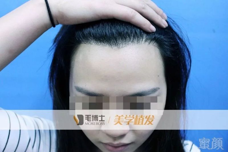 植发际线和纹发际线,性价比高的居然是"它"