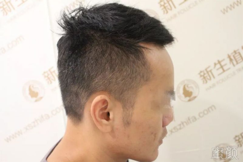 男士鬓角种植,术后男人味十足