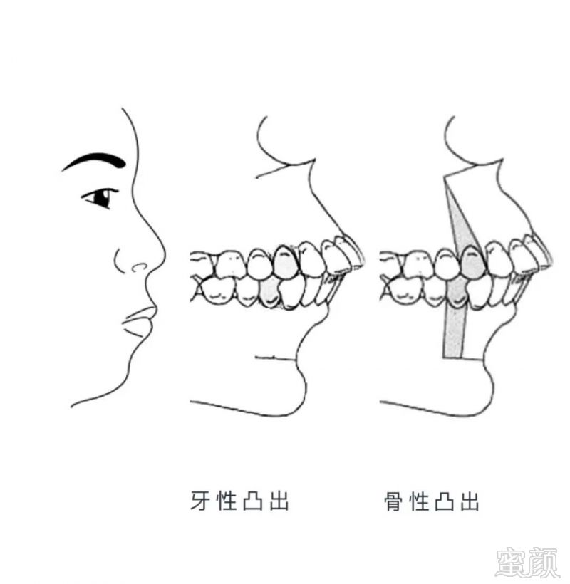 「骨性凸嘴」上下颌发育过度,牙槽骨本身的畸形,会有两种情况,牙齿