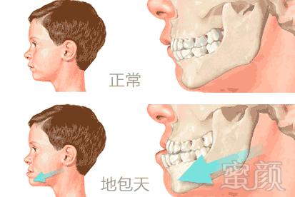 手术精细的点在于,切下骨骼的厚度=下颚后移的距离.