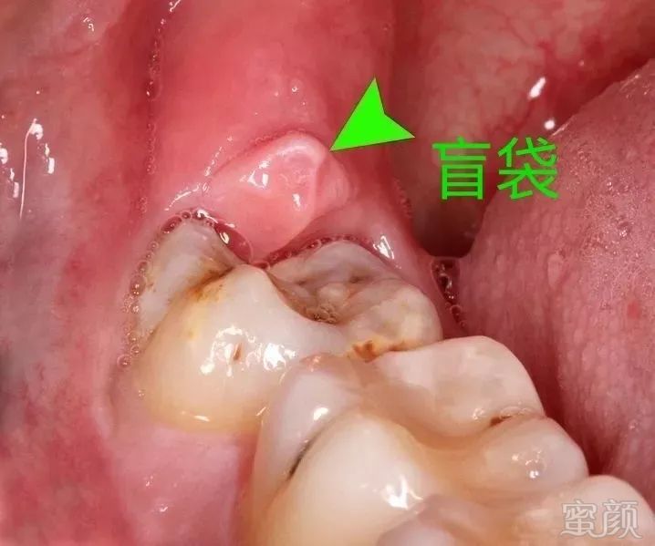 智齿到底应不应该拔?