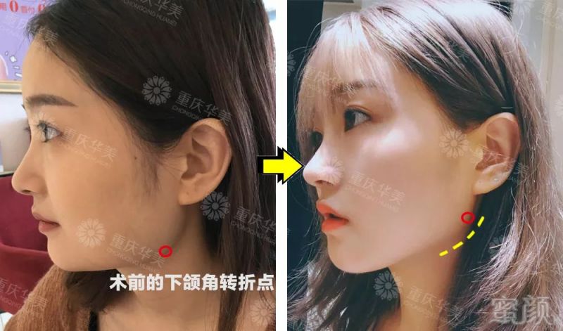 红圈标注了下颌角转折点