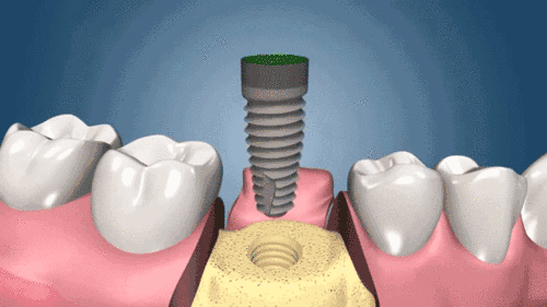 一张图带你了解什么是种植牙