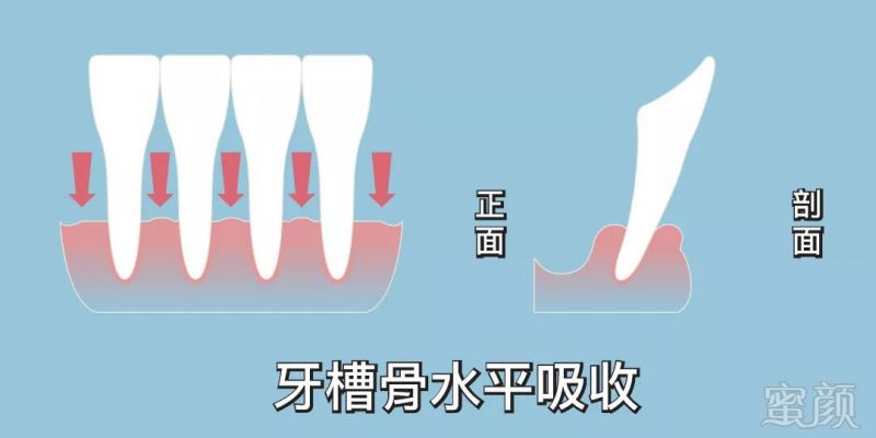 牙槽骨的高度下降三分之一(还剩三分之二)称为轻度吸收