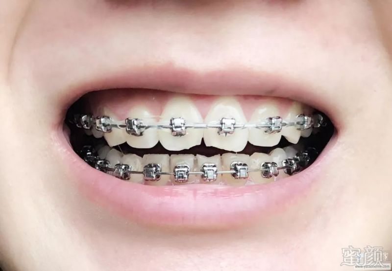 牙套完成|26岁女1年半金属自锁正畸,已摘牙套
