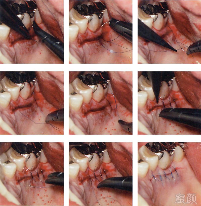 牙槽嵴增高术:天然牙的固定义齿嵌体的桥体案例