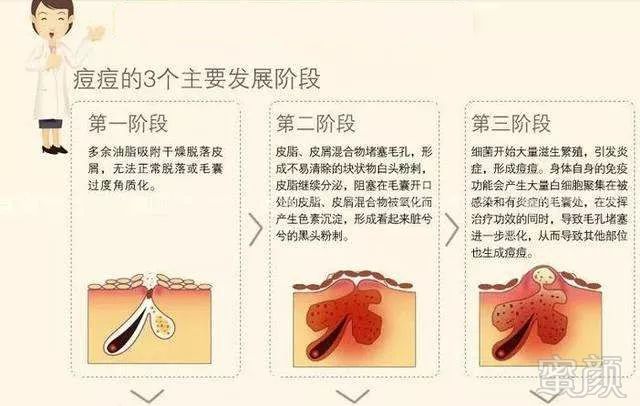 光子嫩肤水杨酸