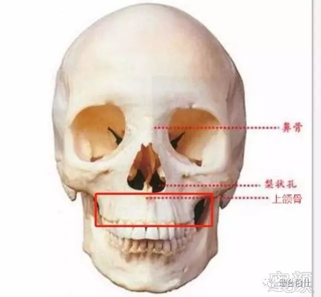 上颌骨发育不全会造成眼下到上唇之间,也就是整个中面部出现一个