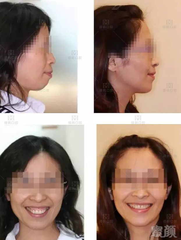龅牙面型——嘴巴外凸