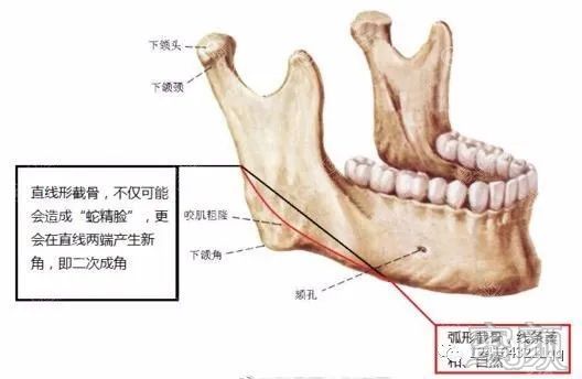 如果10年前做下颌角手术,医生用切除咬肌的方法来瘦脸,属于正常