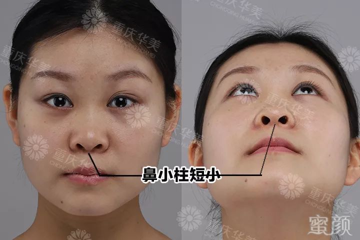 重庆华美美鼻案例杜鹃 三,鼻小柱过宽 表现:通常是鼻中隔与鼻小柱