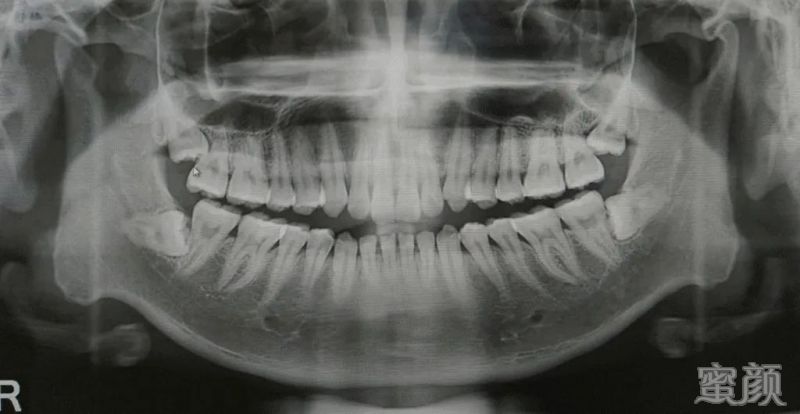 牙齿x光片     如果是 正常萌出的智齿,对口腔健康没有影响, 遵