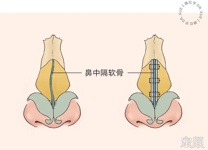 仰视角度更容易理解,截断,去除,复位.