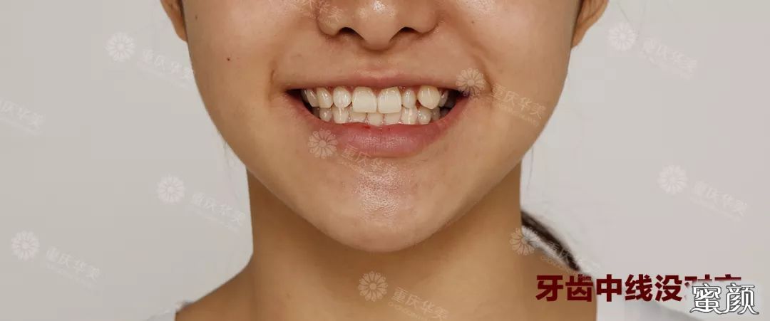经过矫正改善,牙齿中线可以重回到一条线上,笑容更美观自然.