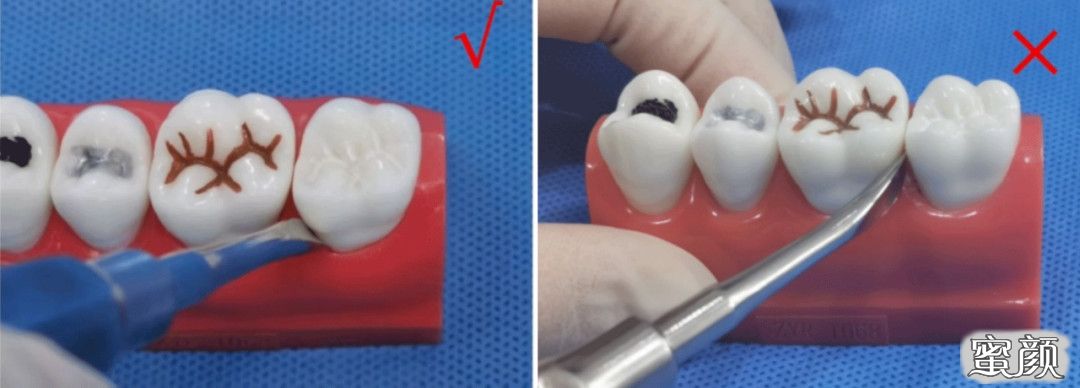 1. 挺子的支点要在牙槽骨而不是邻牙上.