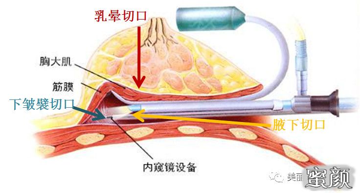 腋下切口到术腔的距离要比下皱襞切口和乳晕切口都要远88图注:看