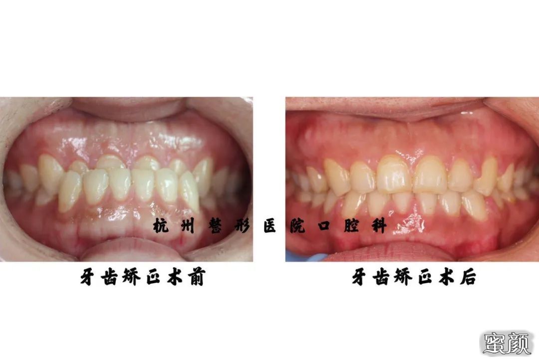 前牙反合:平时常说的"地包天,表现为下牙包住上牙,矫正牙齿后恢复
