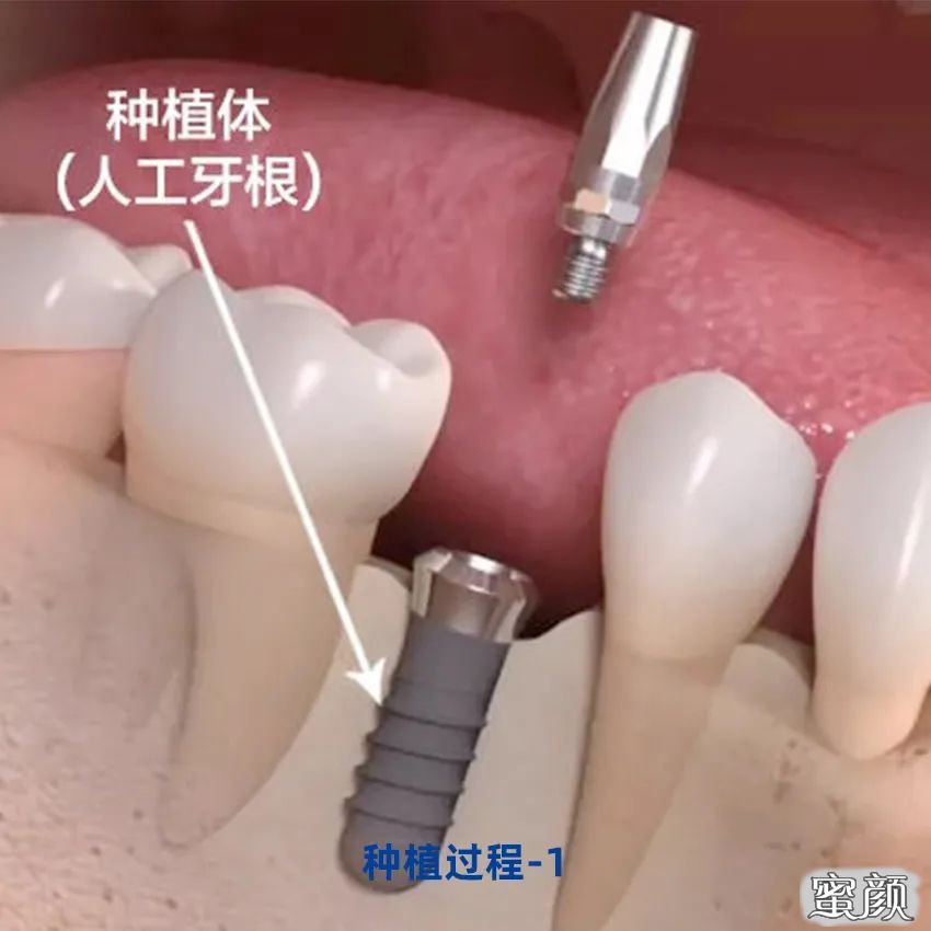 之后,在人体适应人工牙根不出现排斥之后,医生会将基台安装在人工牙根