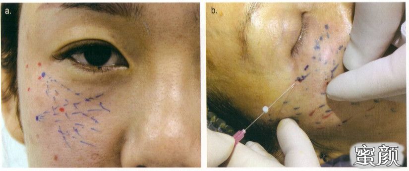 眼周部位的线雕操作!