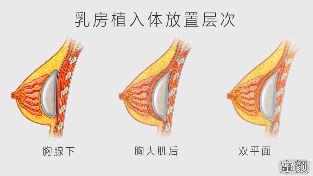 假体植入在乳腺后,胸大肌后或部分胸大肌后部分乳腺后的双平面层次