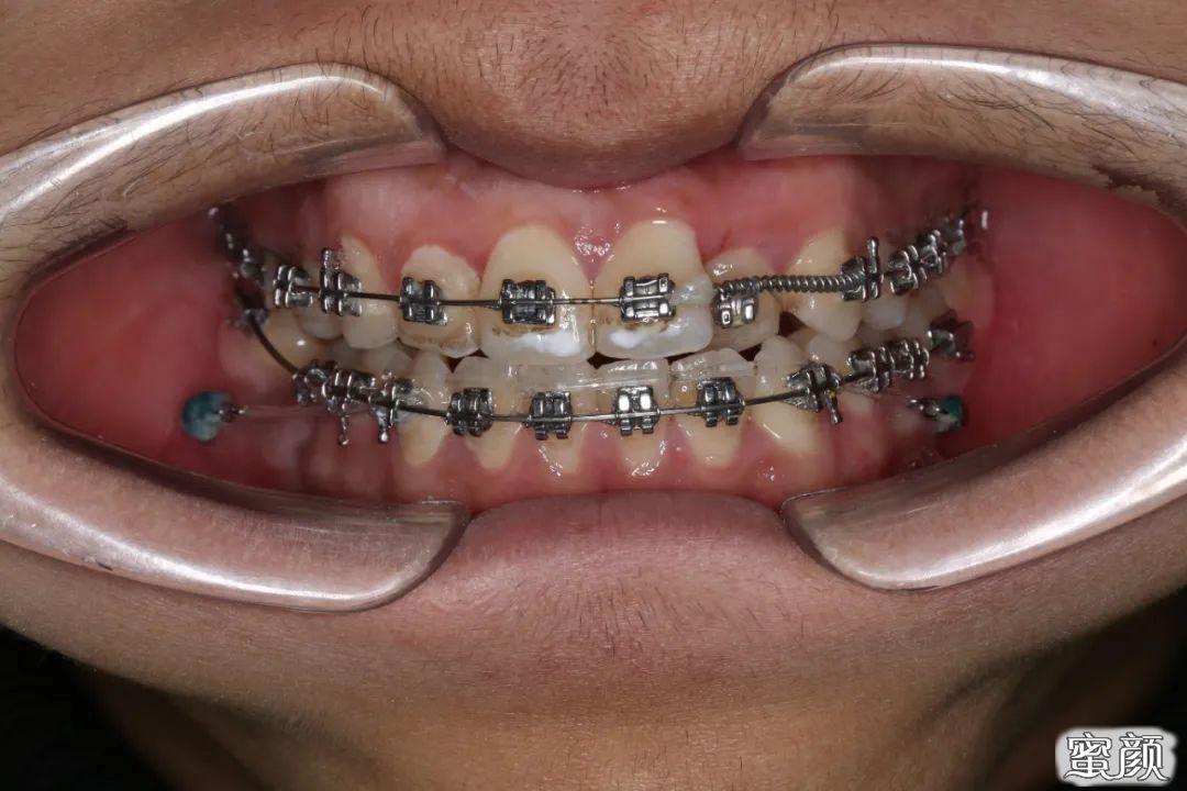 牙齿矫正的最佳年龄是什么时候?