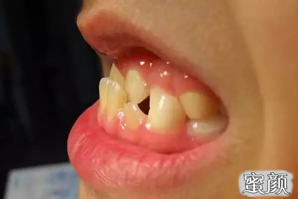 这也就是所谓的"地包牙,是指下排牙齿包住上排牙齿的情况.