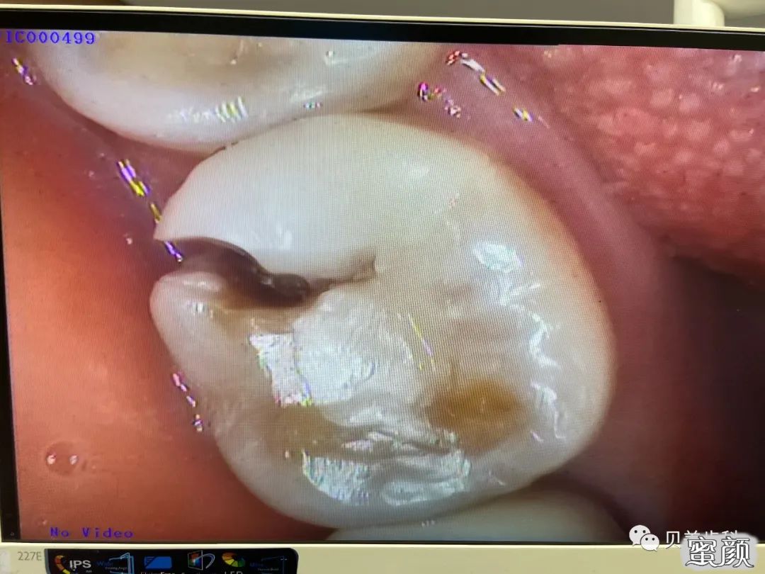 这是一例补牙后没有经过根管治疗而被咬裂的情况         专业