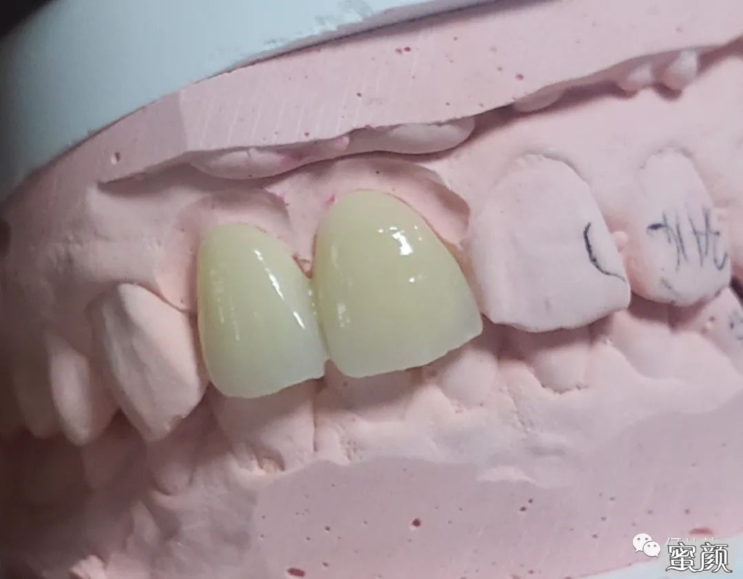 侧切牙残根根管治疗后纤维桩核冠修复