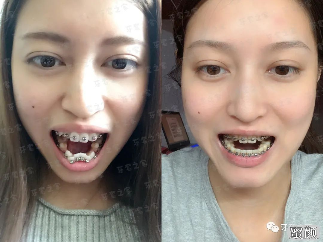 骨性龅牙,拔了8颗牙,矫正3年半,我终于从一个龅牙妹变成一个正常人了